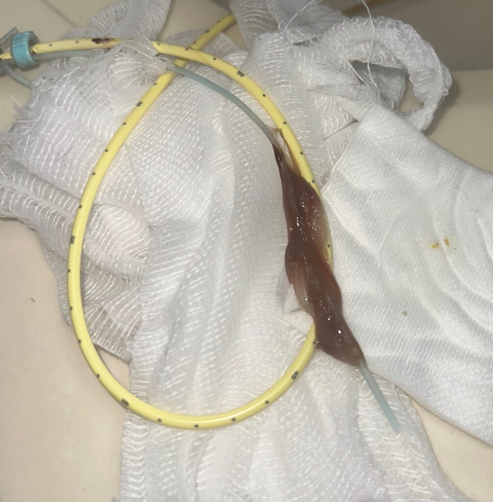 NG Tube Mucus - click to see