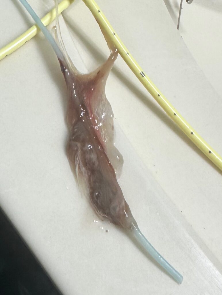 NG Tube Mucus - click to see