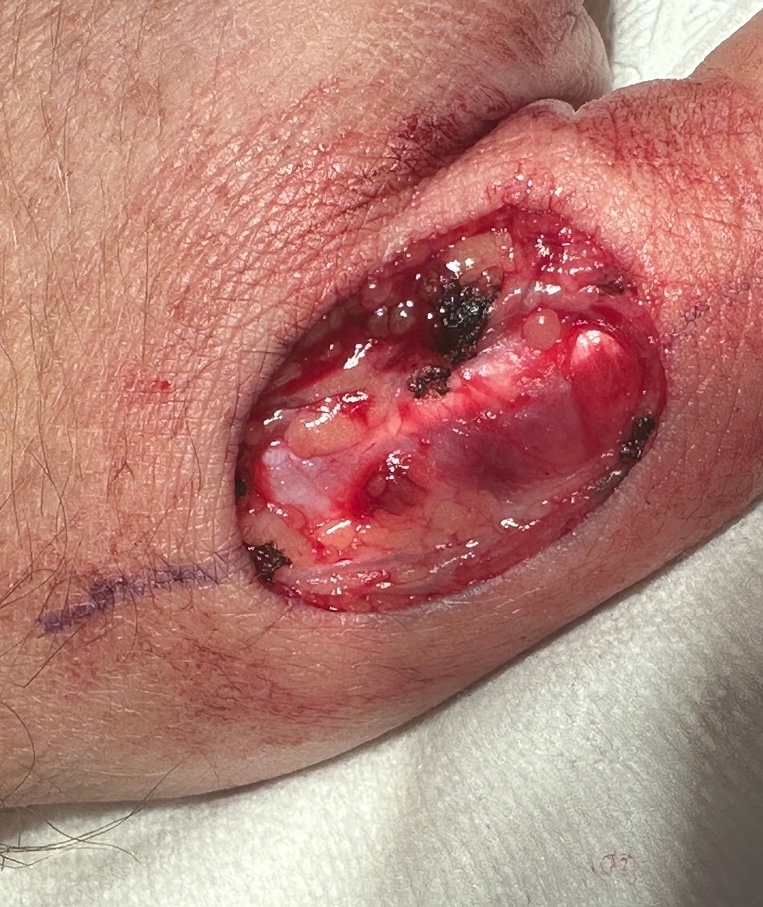My thumb cut open during MOHS